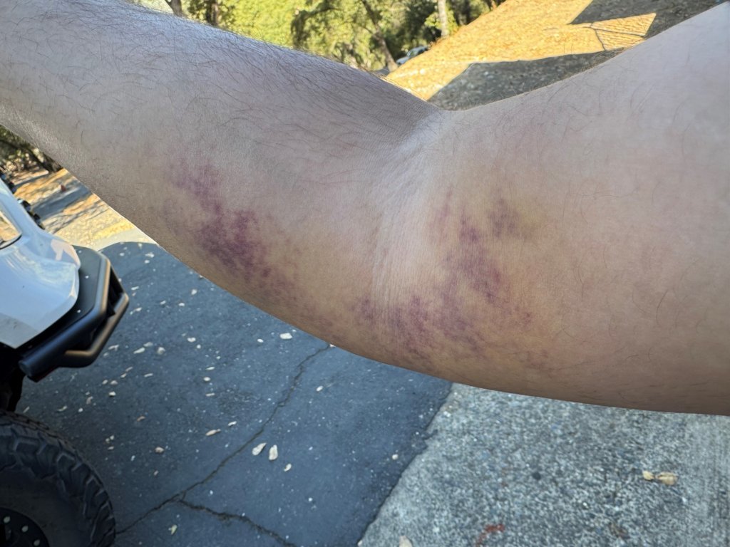 bicep tear.jpg
